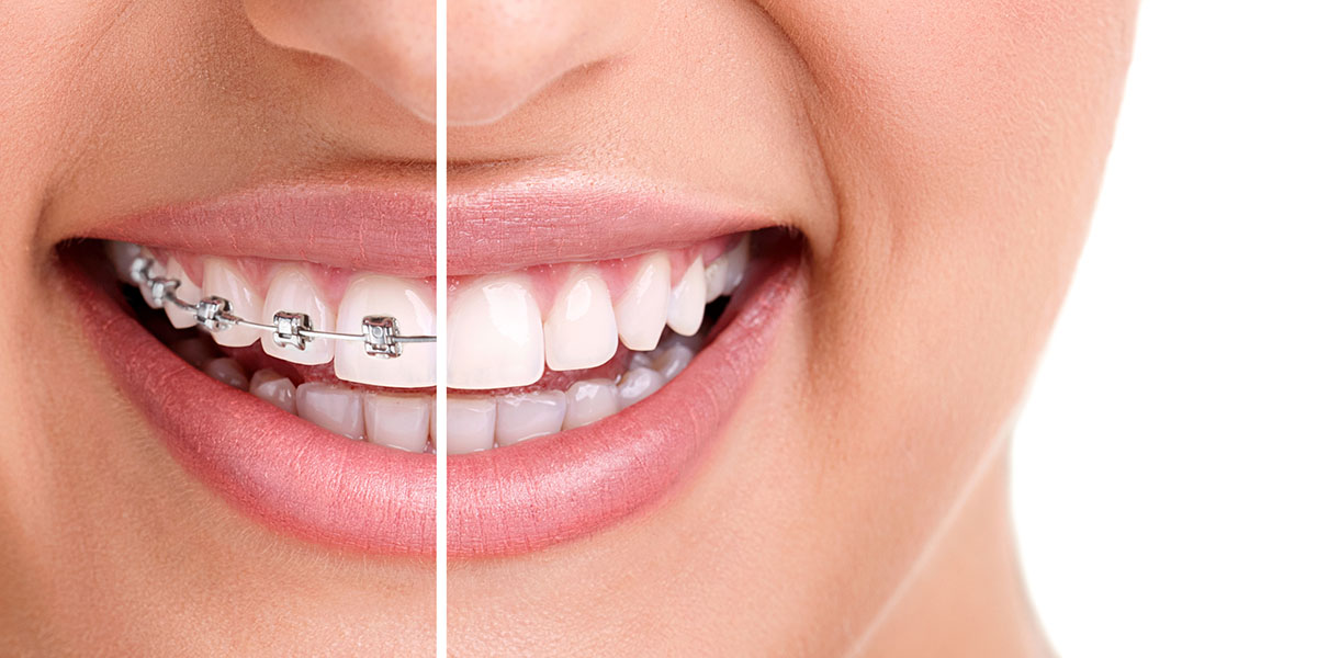 Zähne einer Frau mit und ohne Zahnspange